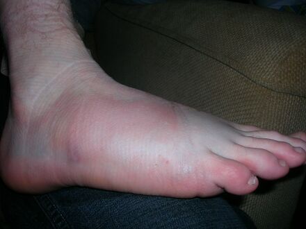 Sprained ankle