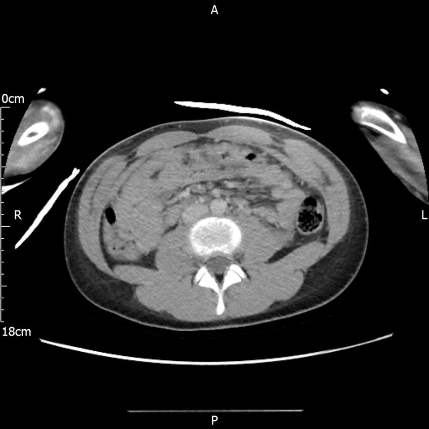 AAST grade IV kidney injury with CEUS follow-up (Radiopaedia 72353-82877 Axial C+ portal venous phase 38).jpg