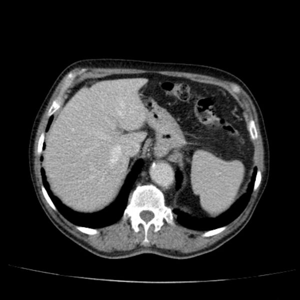 File:Abdominal aortic aneurysm (Radiopaedia 29248-29660 Axial C+ portal venous phase 13).jpg