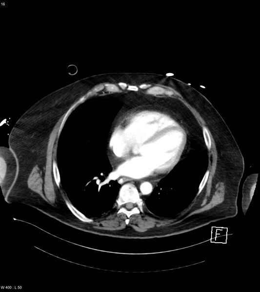 File:Abdominal aortic aneurysm with intramural hematoma then rupture (Radiopaedia 50278-55632 Axial C+ arterial phase 15).jpg