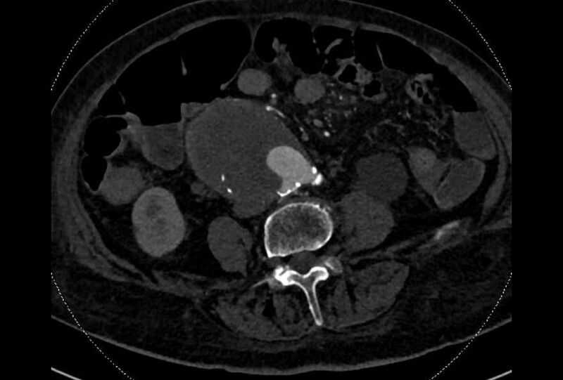 File:Abdominal aortic aneurysm with thrombus fissuration (Radiopaedia 73192-83919 Axial C+ arterial phase 129).jpg