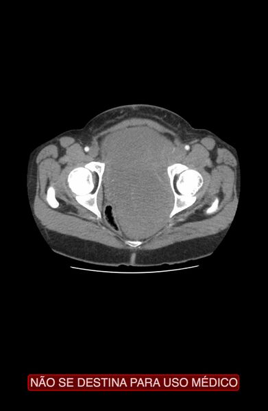 File:Abdominal desmoid tumor (Radiopaedia 44024-47540 Axial C+ arterial phase 50).jpg