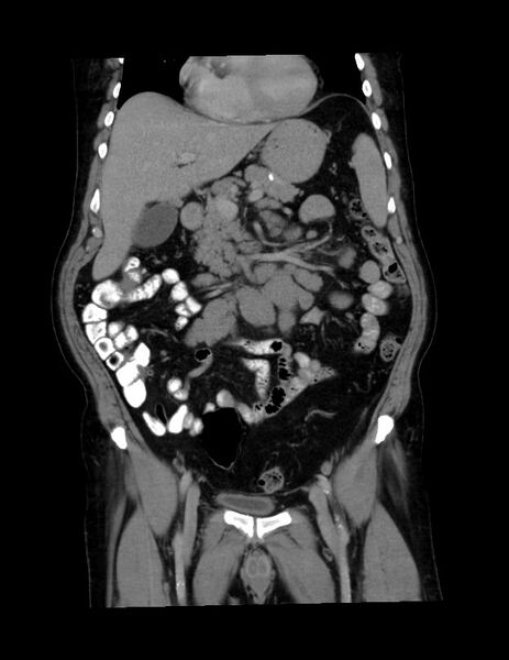 File:Abdominal lymphoma - with sandwich sign (Radiopaedia 53486-59492 C+ portal venous phase 36).jpg