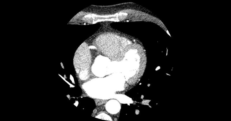 File:Aberrant left main coronary artery (ALMCA) arising from the right sinus with interarterial course (Radiopaedia 63251-71814 Axial C+ arterial phase 82).JPG