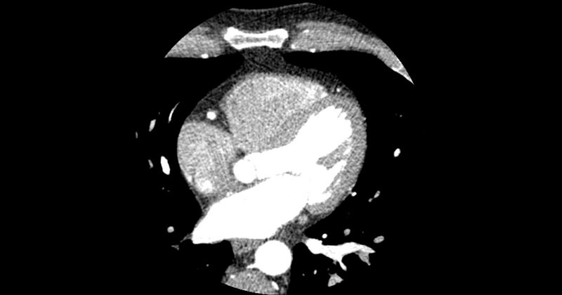 File:Aberrant left main coronary artery (ALMCA) arising from the right sinus with interarterial course (Radiopaedia 63251-71814 Axial C+ arterial phase 97).JPG