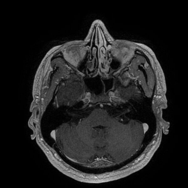 File:Acoustic schwannoma - intracanalicular (Radiopaedia 37247-39024 Axial T1 C+ 67).jpg