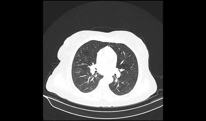 File:Acquired tracheo-esophageal fistula (Radiopaedia 51356-57103 Axial lung window 22).jpg