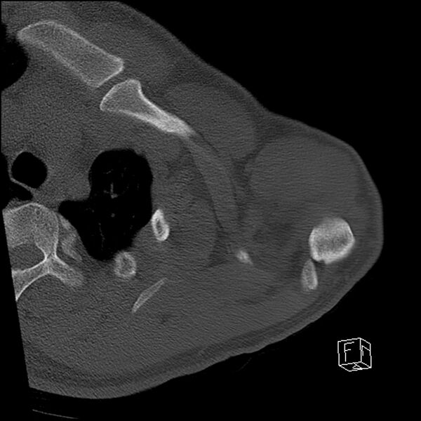 File:Acromioclavicular joint dissociation - type IV (Radiopaedia 64411-73216 Axial bone window 12).jpg