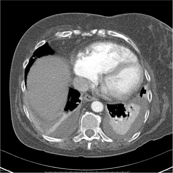 File:Acute-on-chronic pulmonary emboli (Radiopaedia 27925-28169 C+ CTPA 60).jpg