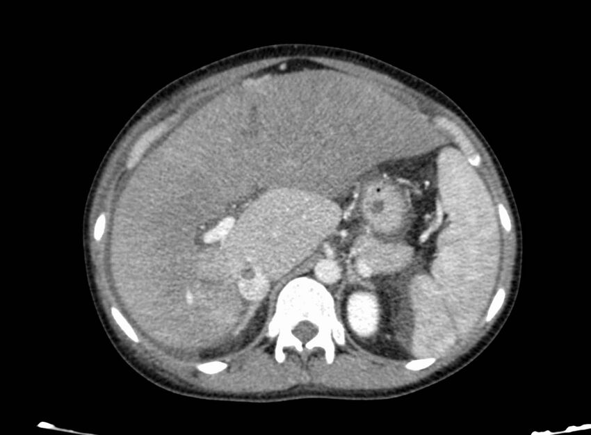 Acute Budd-Chiari syndrome (Radiopaedia 60858-68638 Axial C+ portal venous phase 92).jpg