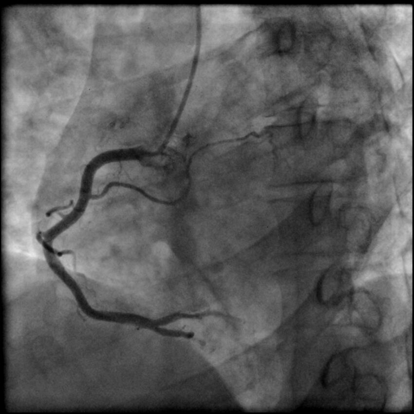 Acute anteroseptal myocardial infarction (Radiopaedia 68409-77946 RAO straight RCA 21).jpg