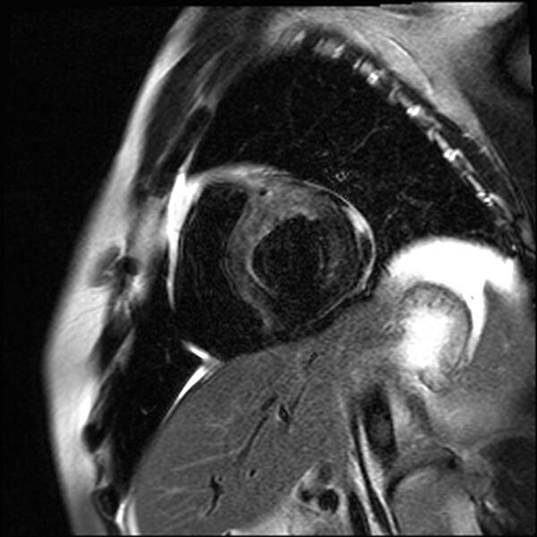 File:Acute anteroseptal myocardial infarction (Radiopaedia 68409-77947 Short axis T2 3).jpg