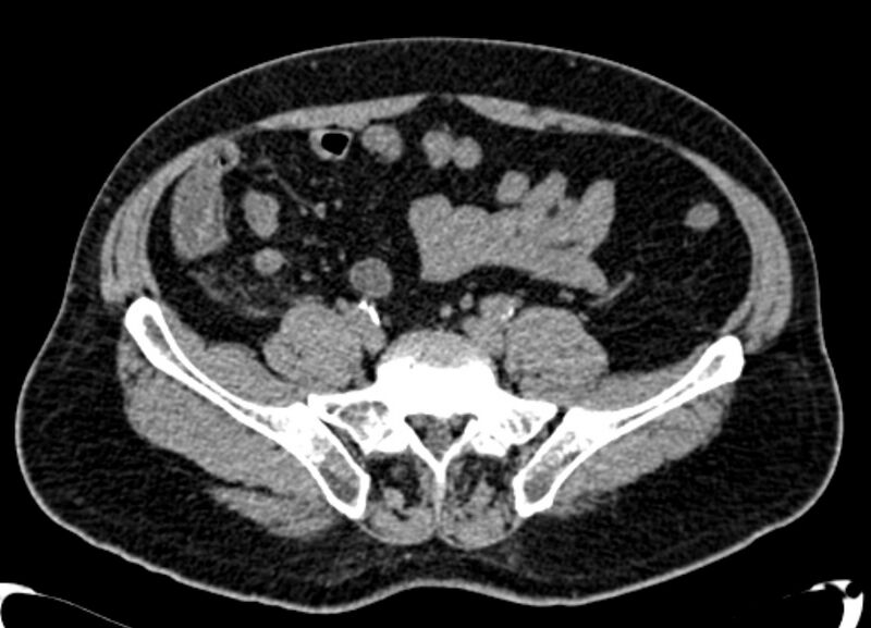 File:Acute appendicitis (Radiopaedia 13030-13091 Axial non-contrast 21).jpg