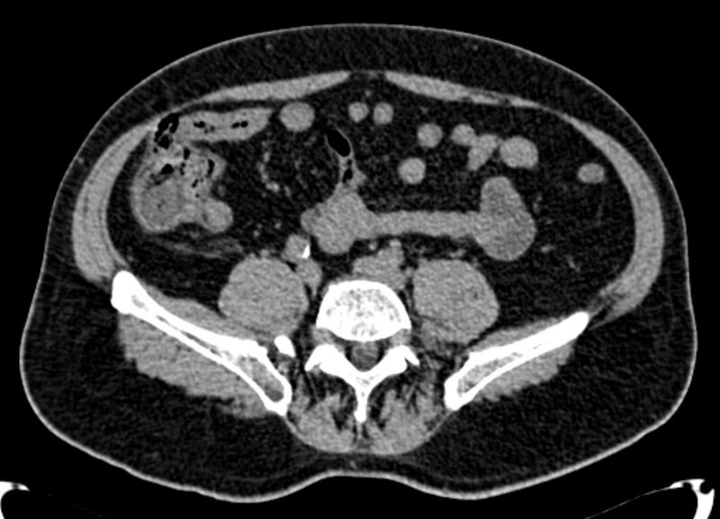 File:Acute appendicitis (Radiopaedia 13030-13091 Axial non-contrast 7).jpg