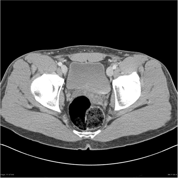 File:Acute appendicitis (Radiopaedia 25364-25615 B 67).jpg