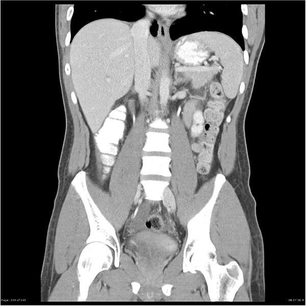 File:Acute appendicitis (Radiopaedia 25364-25615 C+ portal venous phase 16).jpg