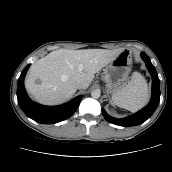 File:Acute appendicitis (Radiopaedia 27049-27227 Axial C+ portal venous phase 13).jpg