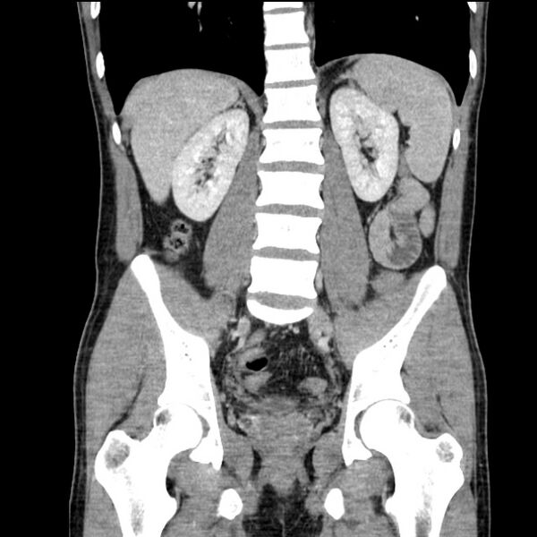 File:Acute appendicitis (Radiopaedia 27049-27227 Coronal C+ portal venous phase 36).jpg