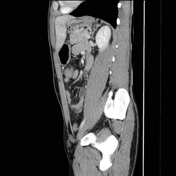 File:Acute appendicitis (Radiopaedia 27049-27227 Sagittal C+ portal venous phase 53).jpg