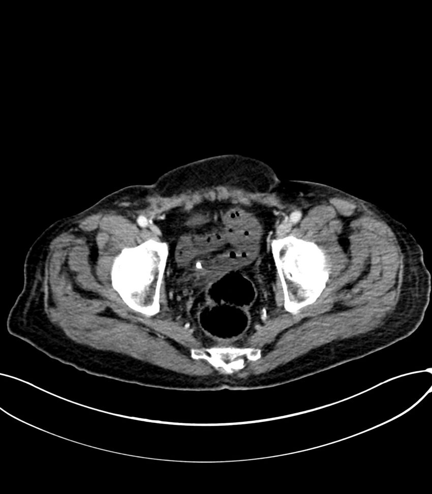 Acute arterial mesenteric ischemia (Radiopaedia 78238-90828 Axial C+ portal venous phase 128).jpg