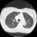 Acute chest syndrome - sickle cell disease (Radiopaedia 42375-45499 Axial lung window 60).jpg
