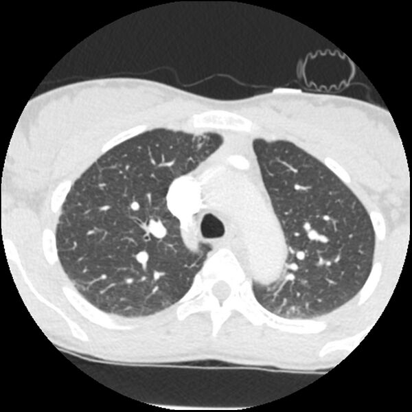 File:Acute chest syndrome - sickle cell disease (Radiopaedia 42375-45499 Axial lung window 60).jpg