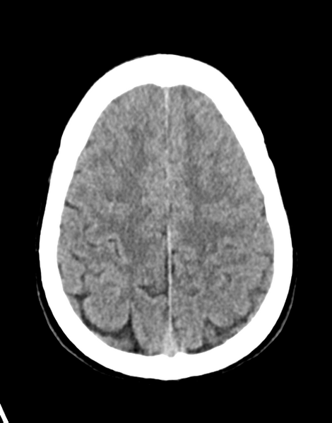 File:Acute disseminated encephalomyelitis (ADEM) (Radiopaedia 65319-74348 Axial non-contrast 25).png