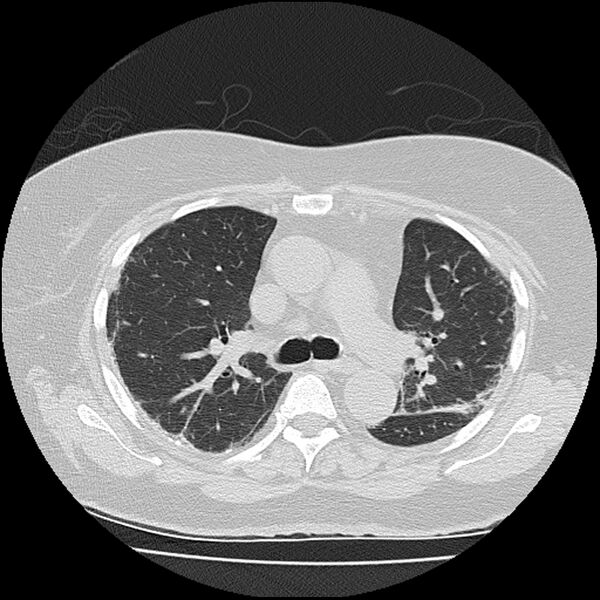 File:Acute interstitial pneumonitis (Radiopaedia 45404-49452 Axial lung window 37).jpg