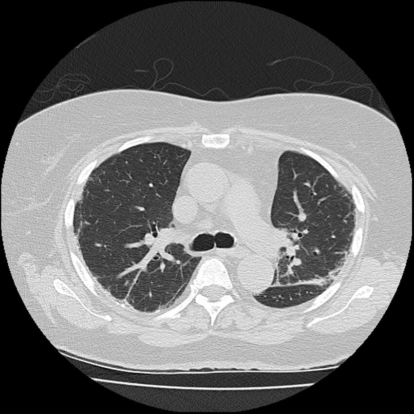 Acute interstitial pneumonitis (Radiopaedia 45404-49452 Axial lung window 37).jpg