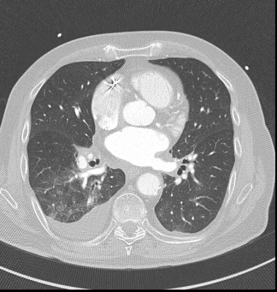 File:Acute myocardial infarction (Radiopaedia 23413-23481 lung window 35).jpg