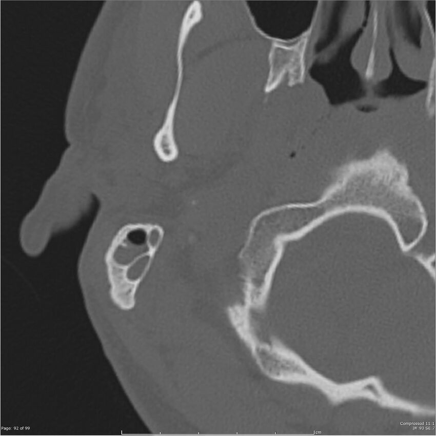 Acute otomastoiditis (Radiopaedia 28276-28512 Axial PTB bone window reformat 72).jpg