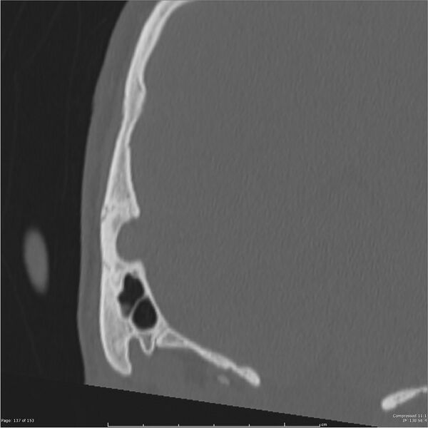 File:Acute otomastoiditis (Radiopaedia 28276-28512 Coronal PTB bone window reformat 68).jpg