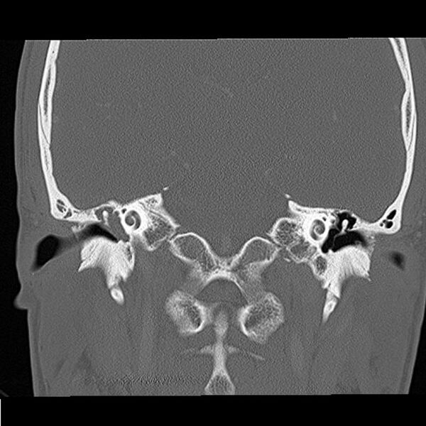 File:Acute otomastoiditis (Radiopaedia 28329-28575 Coronal bone window 12).jpg