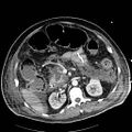 Acute pancreatic necrosis (Radiopaedia 13560-18502 Axial C+ portal venous phase 33).jpg