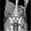 Acute pancreatitis (Radiopaedia 19135-19116 Coronal non-contrast 34).jpg