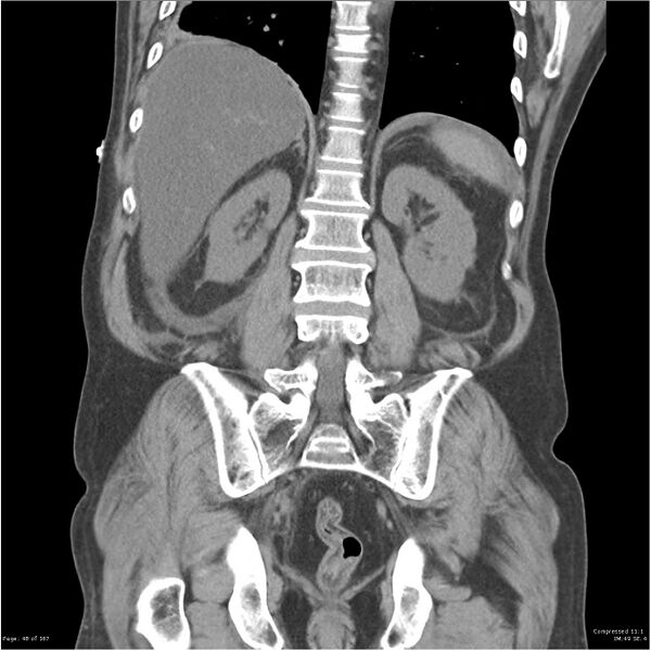 File:Acute pancreatitis (Radiopaedia 19135-19116 Coronal non-contrast 34).jpg