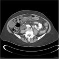 Acute pancreatitis (Radiopaedia 19136-19117 Axial C+ portal venous phase 27).jpg