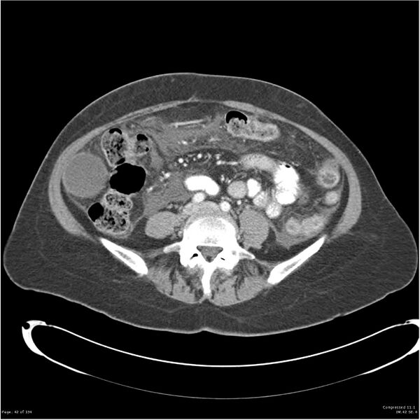 File:Acute pancreatitis (Radiopaedia 19136-19117 Axial C+ portal venous phase 27).jpg
