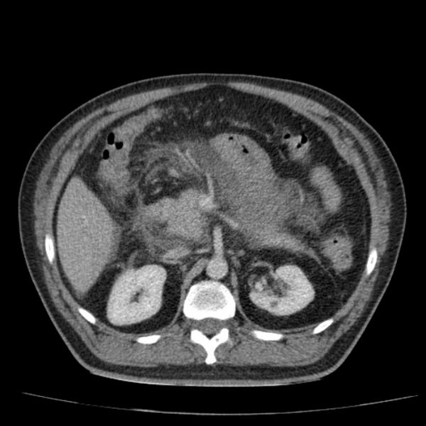 File:Acute pancreatitis (Radiopaedia 26663-26813 Axial C+ portal venous phase 30).jpg