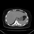 Acute pancreatitis - Balthazar C (Radiopaedia 26569-26714 Axial non-contrast 20).jpg