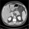 Acute pancreatitis - mild (Radiopaedia 27796-28033 C+ portal venous phase 7).jpg