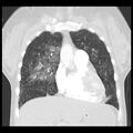 Acute pulmonary edema on CT (Radiopaedia 33582-34672 Coronal lung window 10).jpg