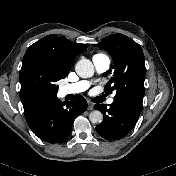 File:Acute pulmonary embolism (Radiopaedia 81677-95570 Axial C+ CTPA 46).jpg