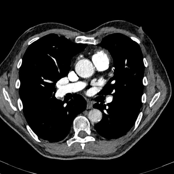 File:Acute pulmonary embolism (Radiopaedia 81677-95570 Axial C+ CTPA 48).jpg