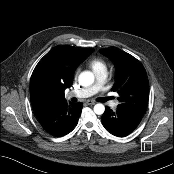 File:Acute pulmonary embolism with pulmonary infarct (Radiopaedia 73062-83768 Axial C+ CTPA 34).jpg
