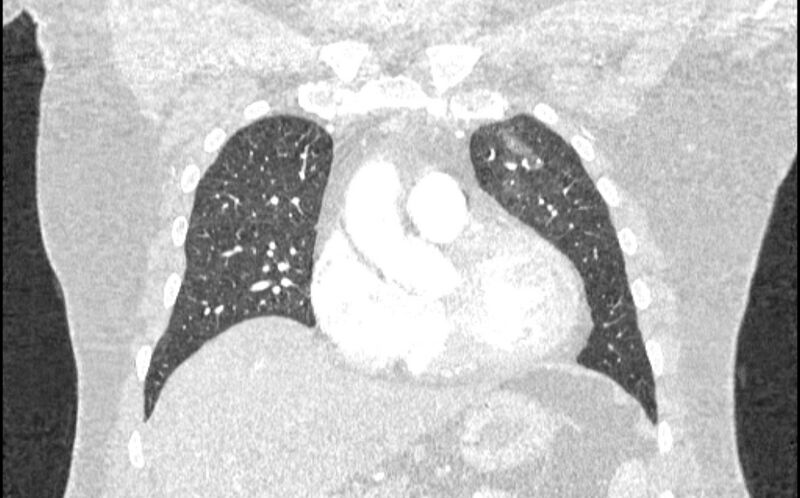 File:Acute pulmonary embolism with pulmonary infarcts (Radiopaedia 77688-89908 Coronal lung window 23).jpg