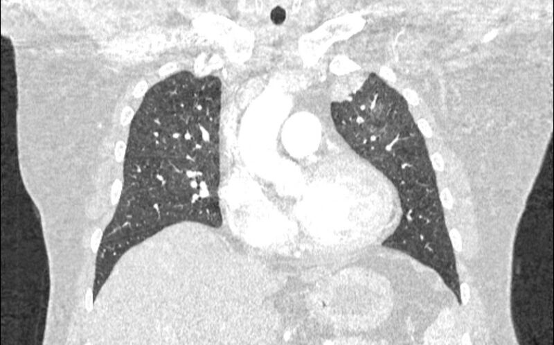 File:Acute pulmonary embolism with pulmonary infarcts (Radiopaedia 77688-89908 Coronal lung window 31).jpg