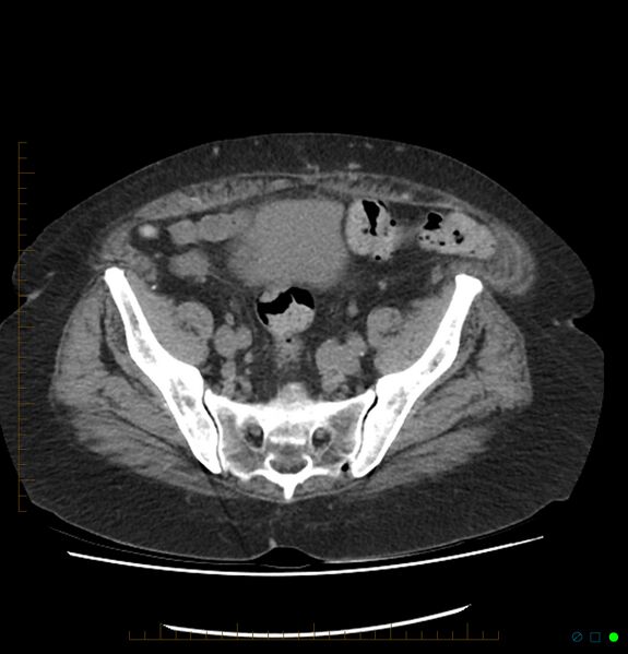 File:Acute renal failure post IV contrast injection- CT findings (Radiopaedia 47815-52557 Axial non-contrast 64).jpg