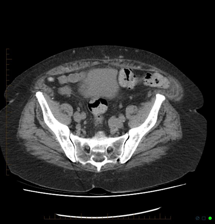 Acute renal failure post IV contrast injection- CT findings (Radiopaedia 47815-52557 Axial non-contrast 64).jpg