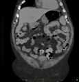 Acute renal failure post IV contrast injection- CT findings (Radiopaedia 47815-52557 Coronal non-contrast 9).jpg